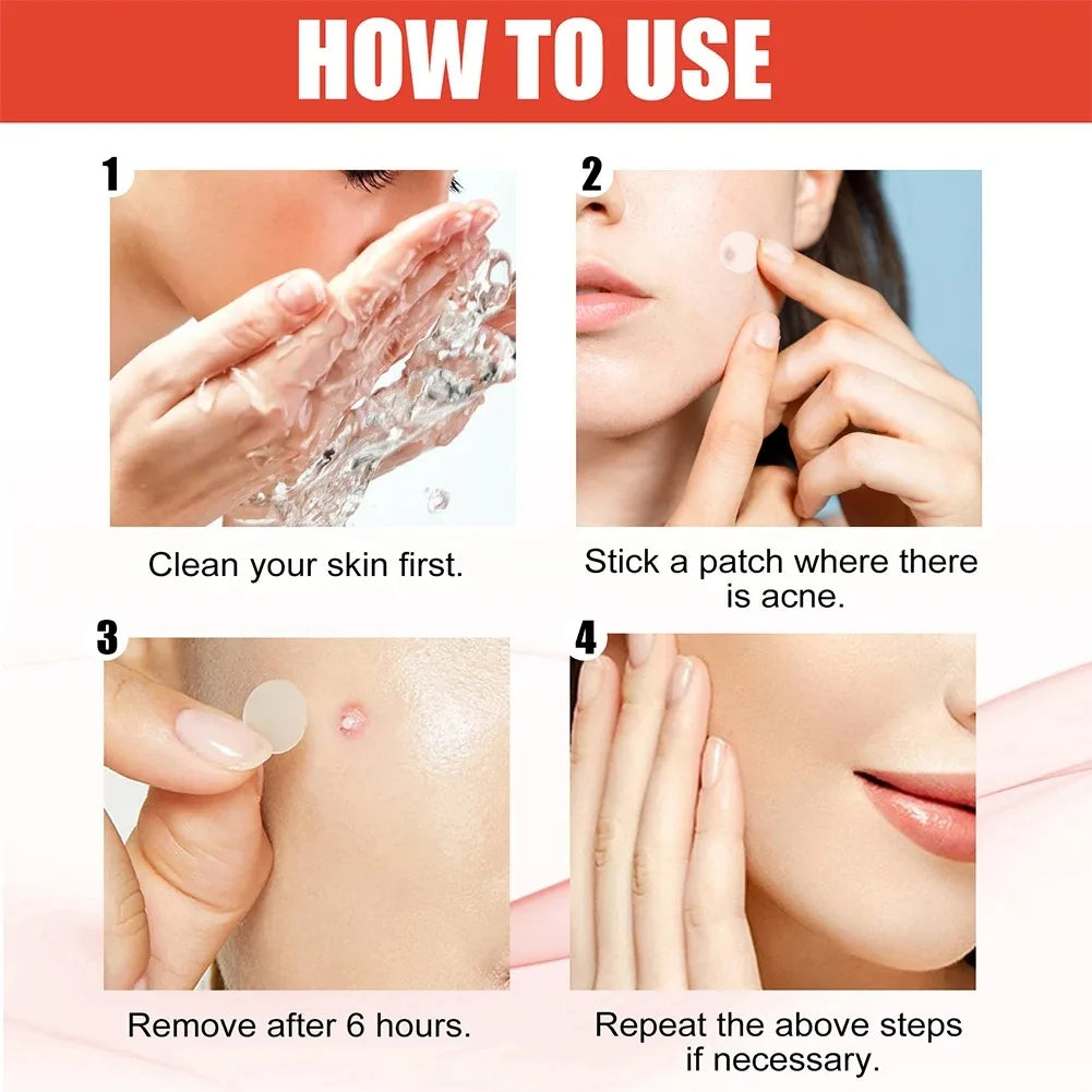 1/2/3 Box Acne Pimple Patches